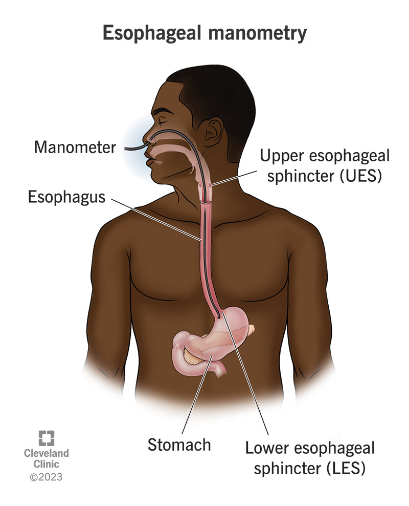 esophageal dysmotility