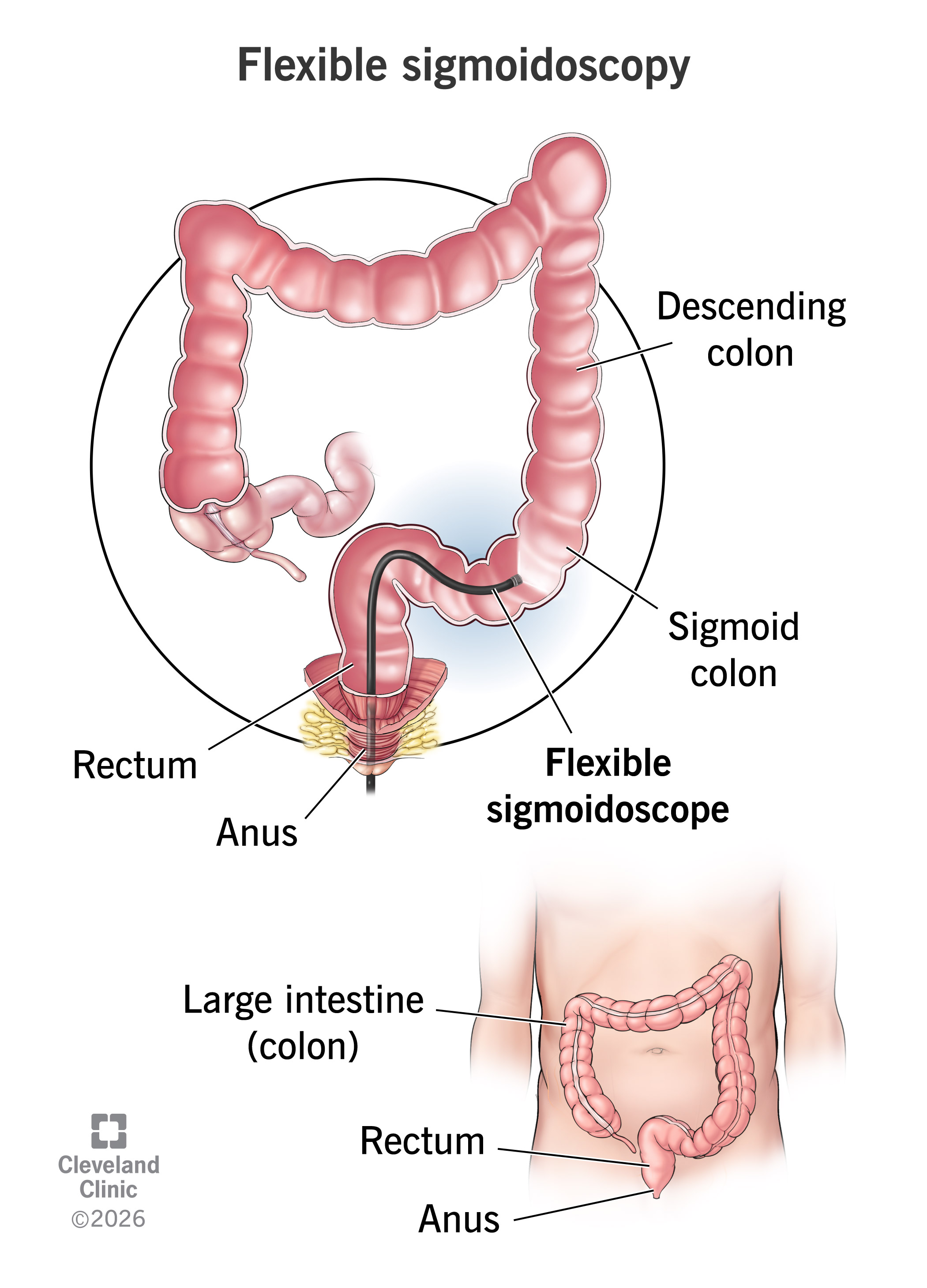 A flexible sigmoidoscope enters through your anus and slowly advances through your rectum and sigmoid colon