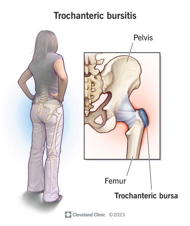 Trochanteric Bursitis: Symptoms, Causes & Treatments