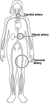 Angiogram en angiografie: tests, behandeling