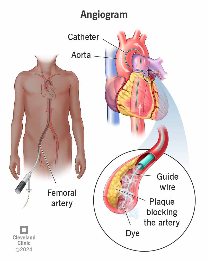 An injection of contrast dye shows blocked blood vessels on an angiogram