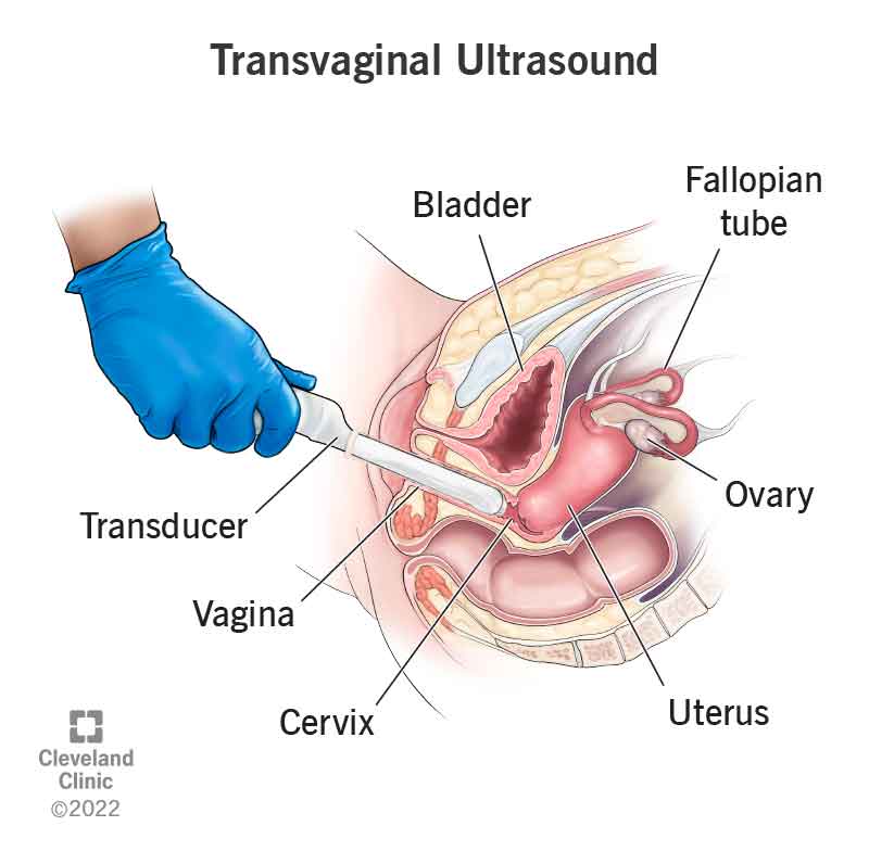 A transducer inserted into the vaginal canal during a transvaginal ultrasound