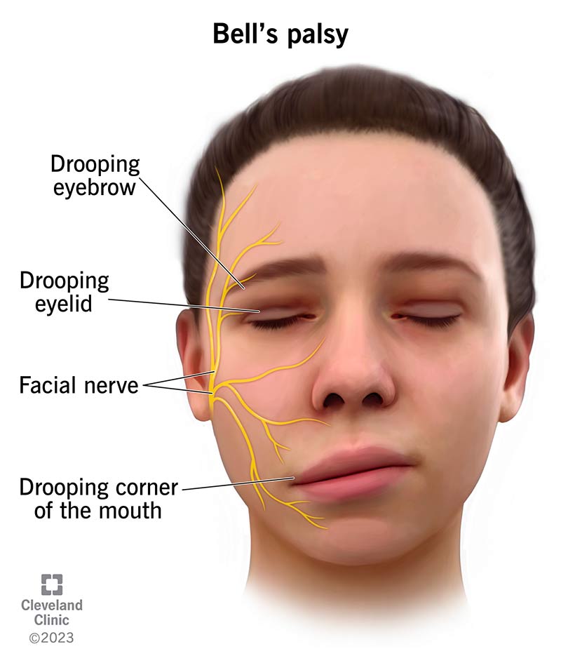 Illustration showing the face of a person with an inflamed facial nerve and drooping of their eyebrow and mouth.
