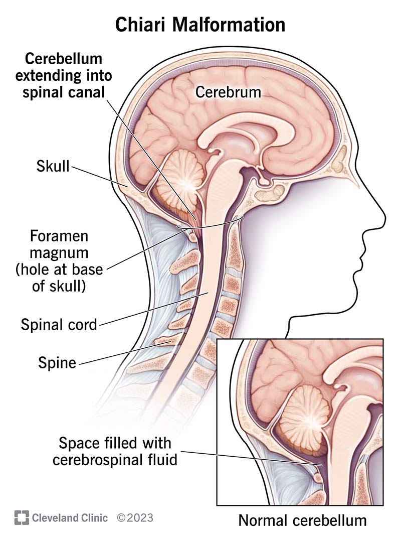 A Chiari malformation where the cerebellum extends into the spinal canal.