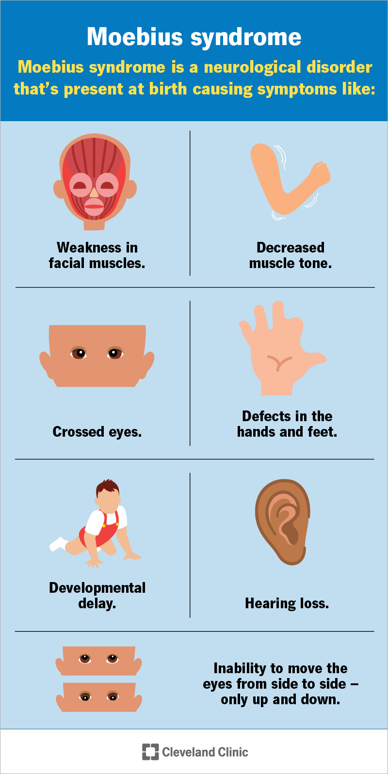 Symptoms of Moebius syndrome are weak facial muscles and muscle tone, crossed eyes, inability to move eyes and more