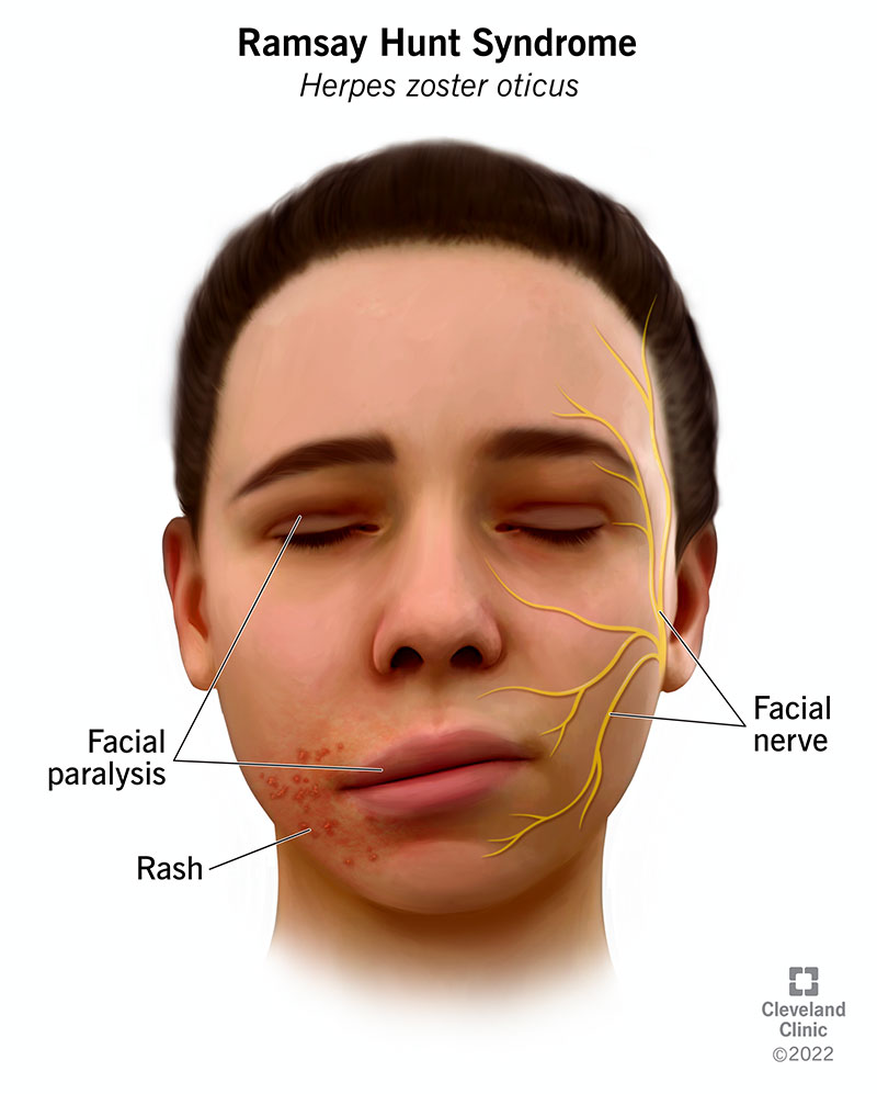 Ramsay Hunt syndrome affects your facial nerve. It may cause facial paralysis and a painful rash on your ear, face and mouth.