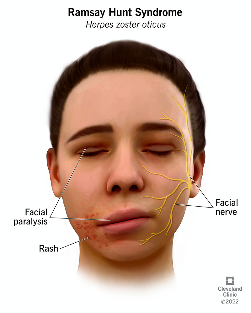 Ramsay Hunt Syndrome What Is It The Essential Guide To Understanding