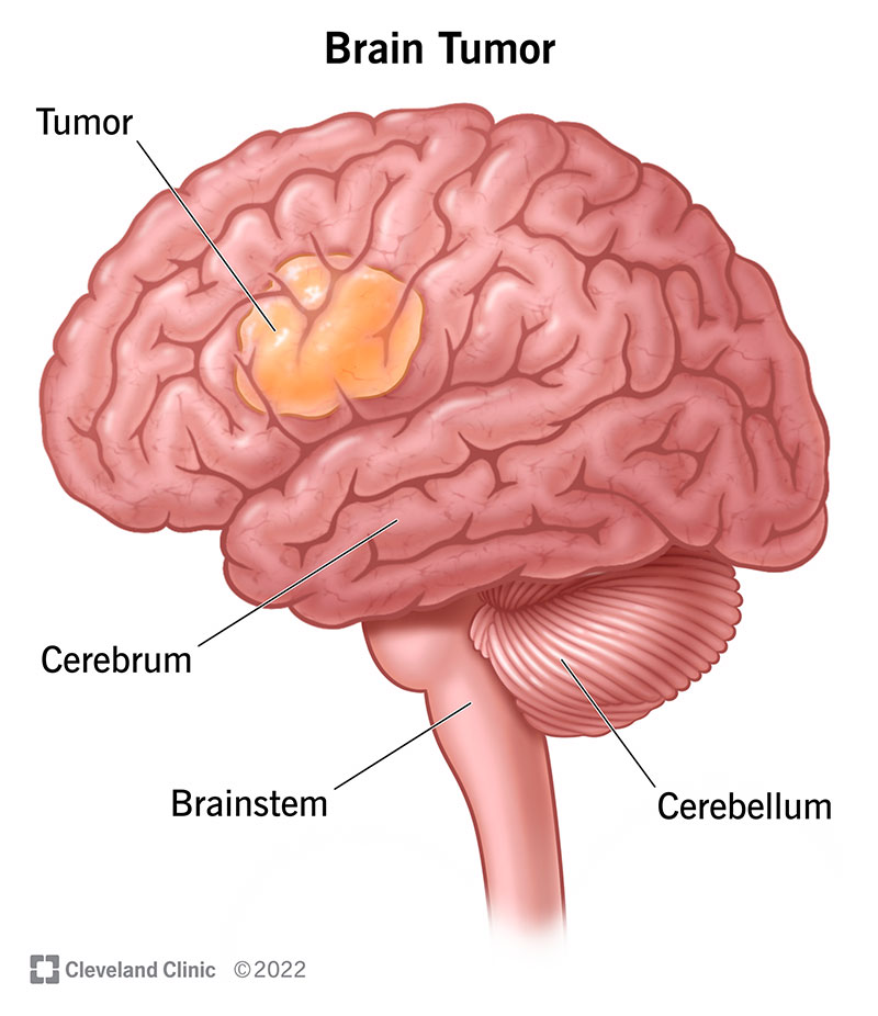 fight brain cancer images