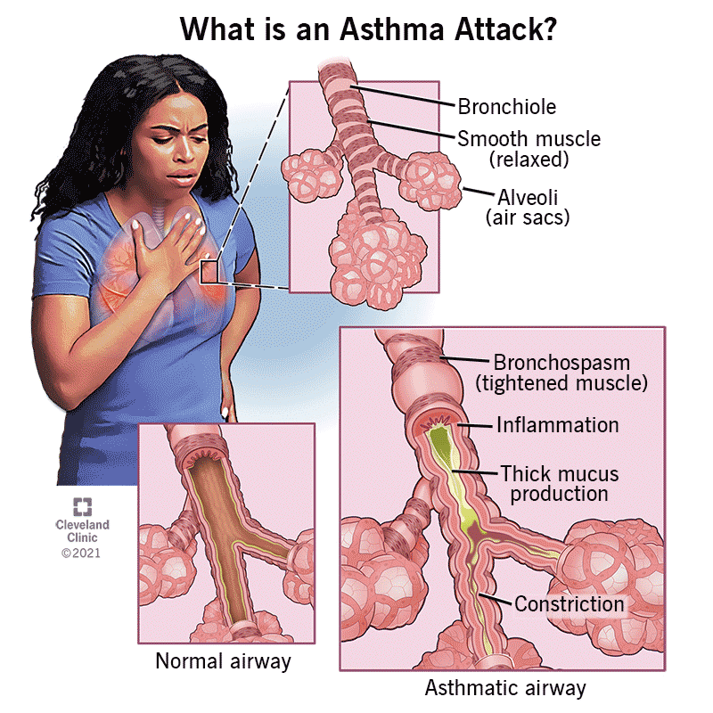 The normal airways of a woman having an asthma attack become constricted, inflamed and full of mucus.
