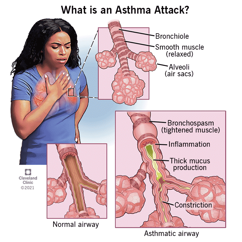 Asthma: Types, Causes, Symptoms, Diagnosis & Treatment