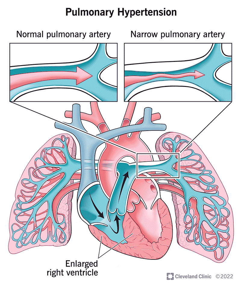 hypertension causes