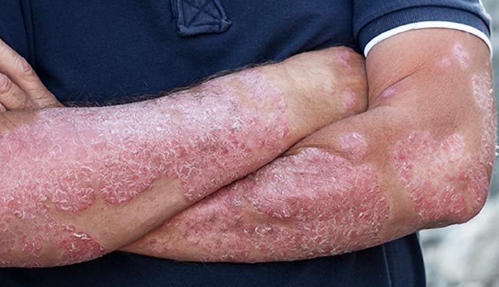 mild psoriasis