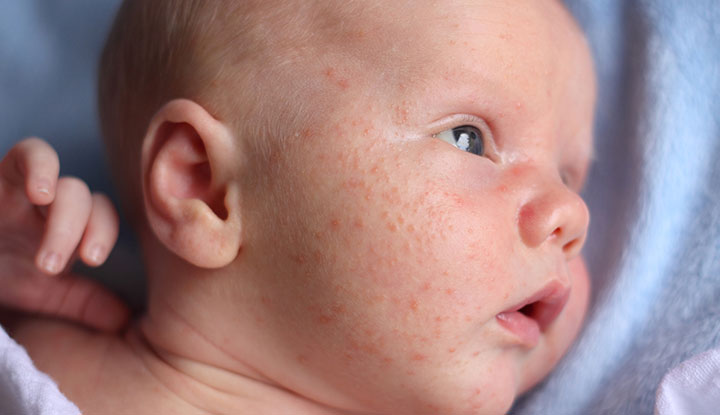 Little white bumps and pink pimples (baby acne) on the face of a baby