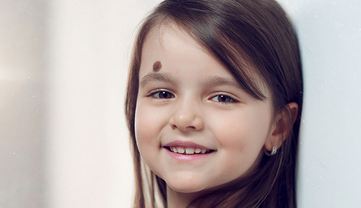 Congenital nevi are moles that your child was born with, though they may not have been as visible at first. Larger moles have a greater risk of becoming skin cancer.