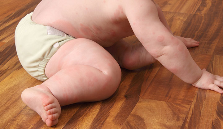 Baby with hives on their legs, abdomen and arms