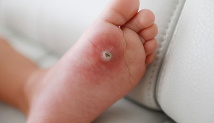 Warts on kids are a type of skin infection caused by HPV. The infection causes hard bumps to form on your child’s skin.