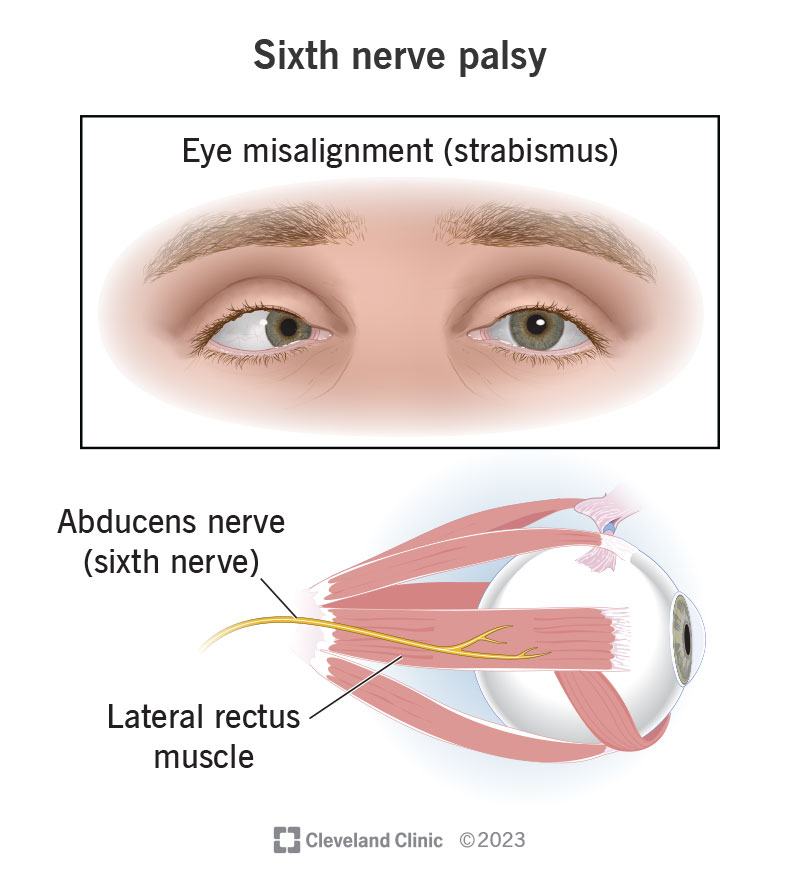 The sixth cranial nerve (abducens nerve) pair controls the muscle on each eye that rotates each eye away from your nose.