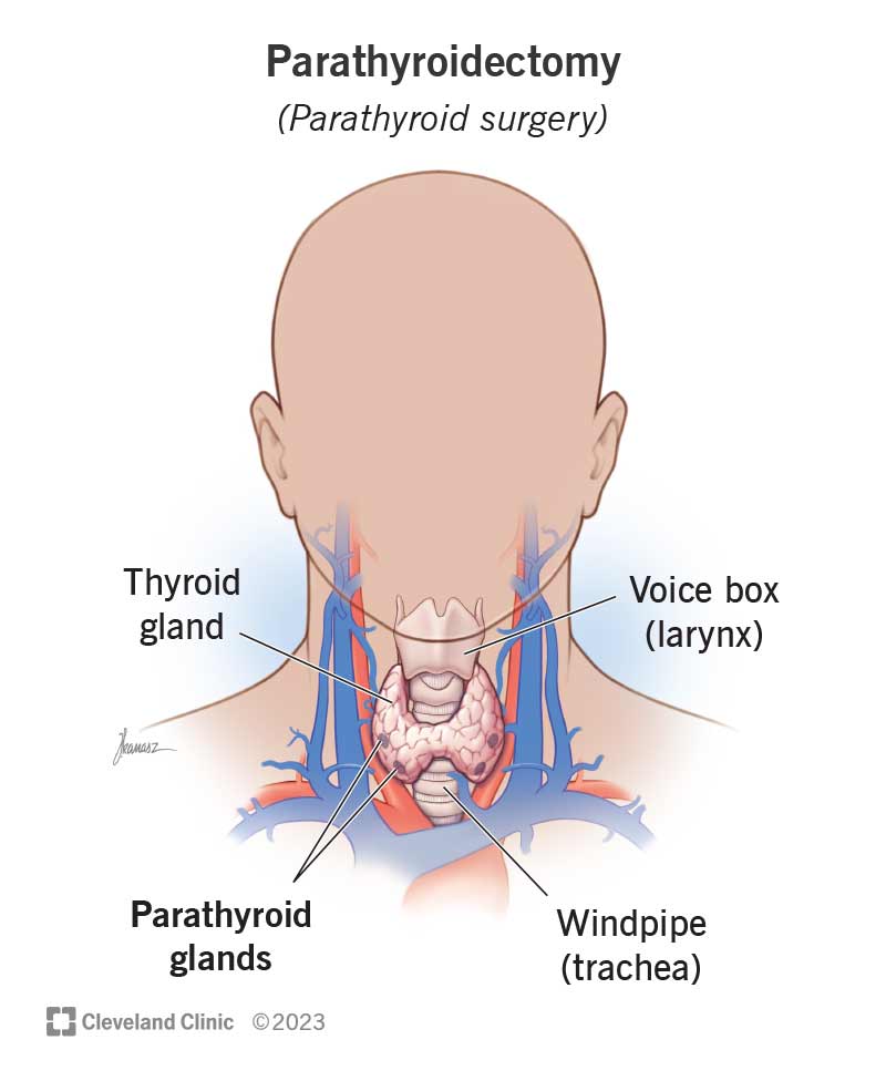 Your parathyroid glands are behind your thyroid gland. Parathyroidectomy refers to the removal of those glands.