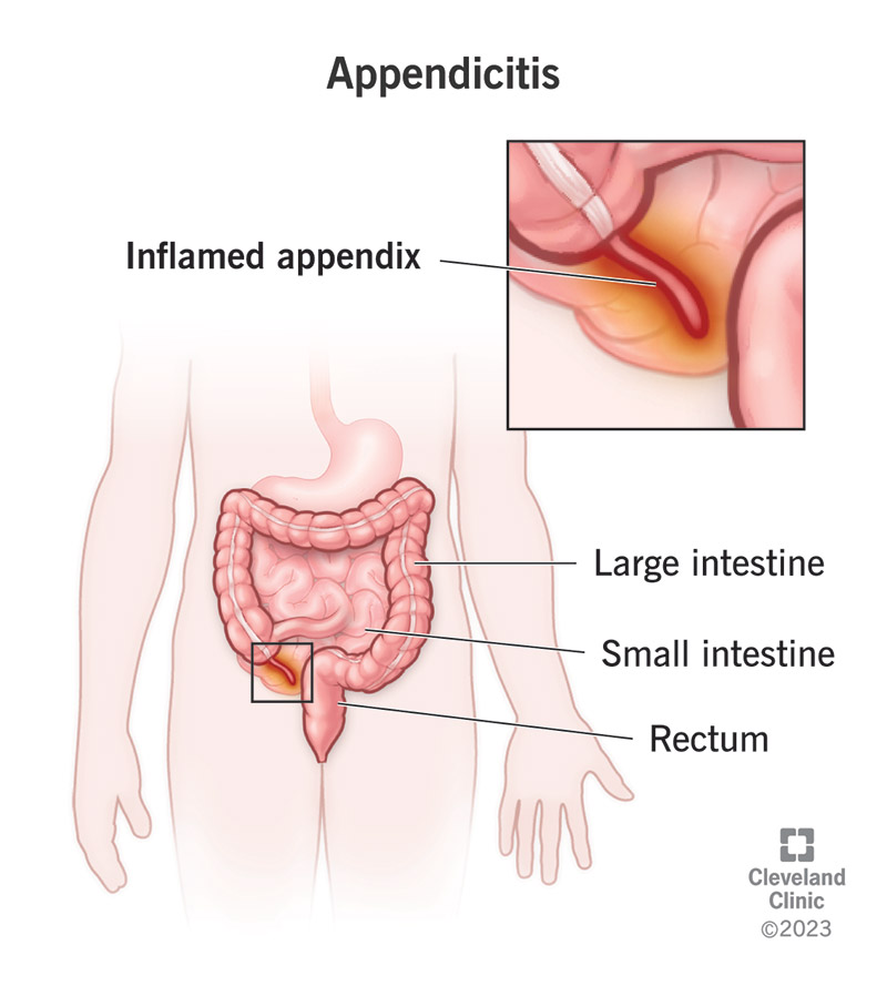 Inflamed appendix, a finger-like organ extending from your large intestine.