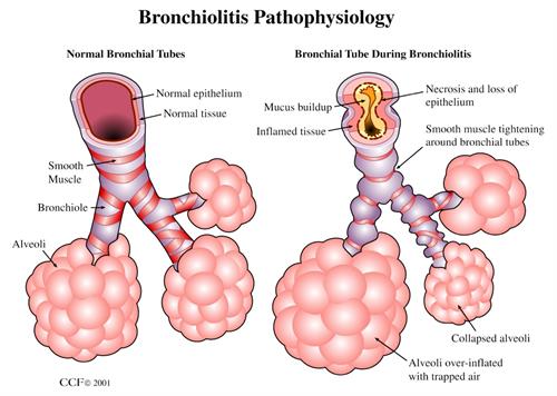 Bronchiolitis Causes Symptoms