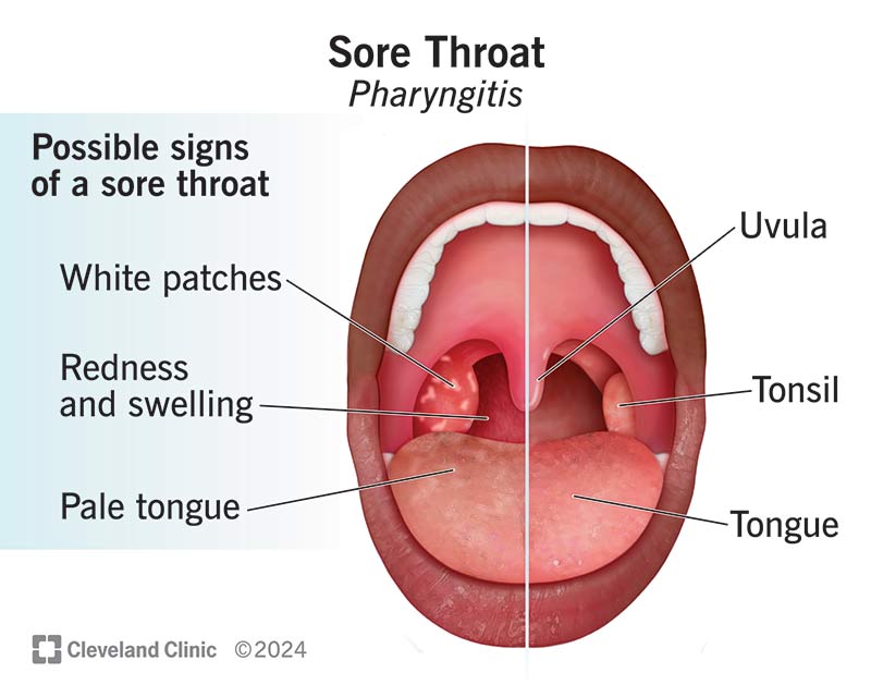 A mouth and throat that’s normal on one side but with signs of a sore throat, like redness and swelling, on the other