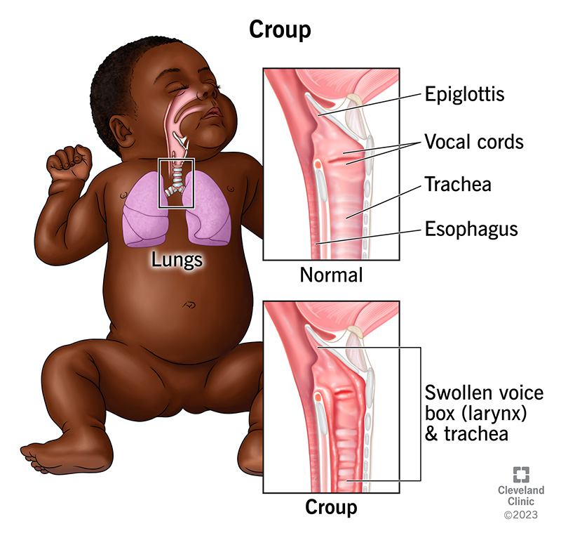 An image of a baby’s airways, showing what a normal voice box (larynx) and windpipe (trachea) look like, and what they look like with croup.
