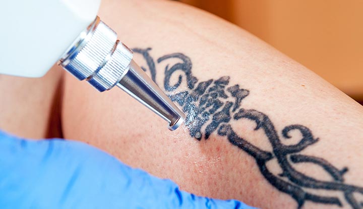 A dermatologist holds a laser against a person’s skin for a tattoo removal procedure.