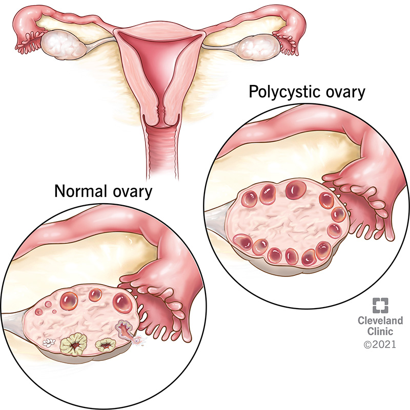 Polycystic Ovary compared to Normal Ovary.