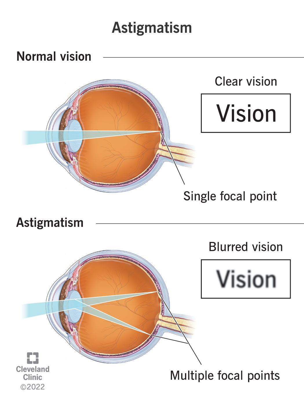 An illustration showing how astigmatism causes blurry vision