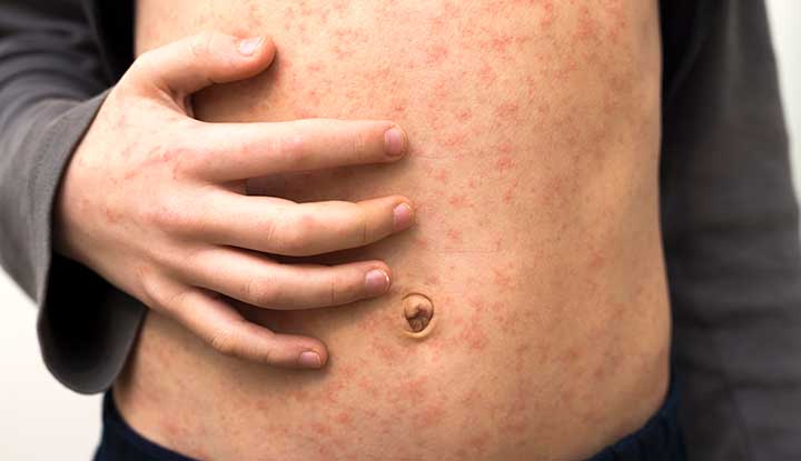 Child with measles on their stomach.