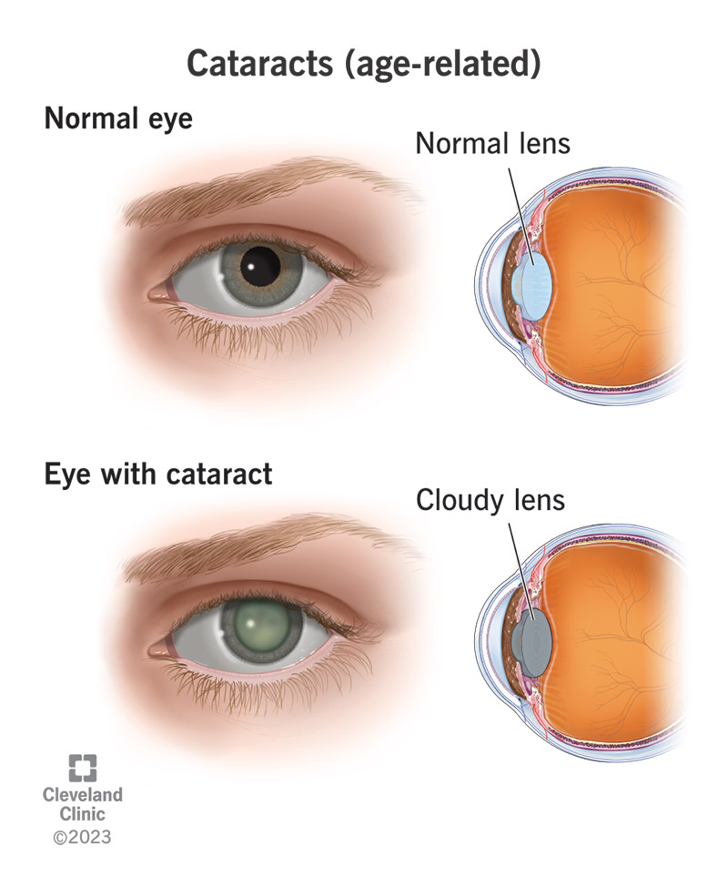Illustration of cataracts