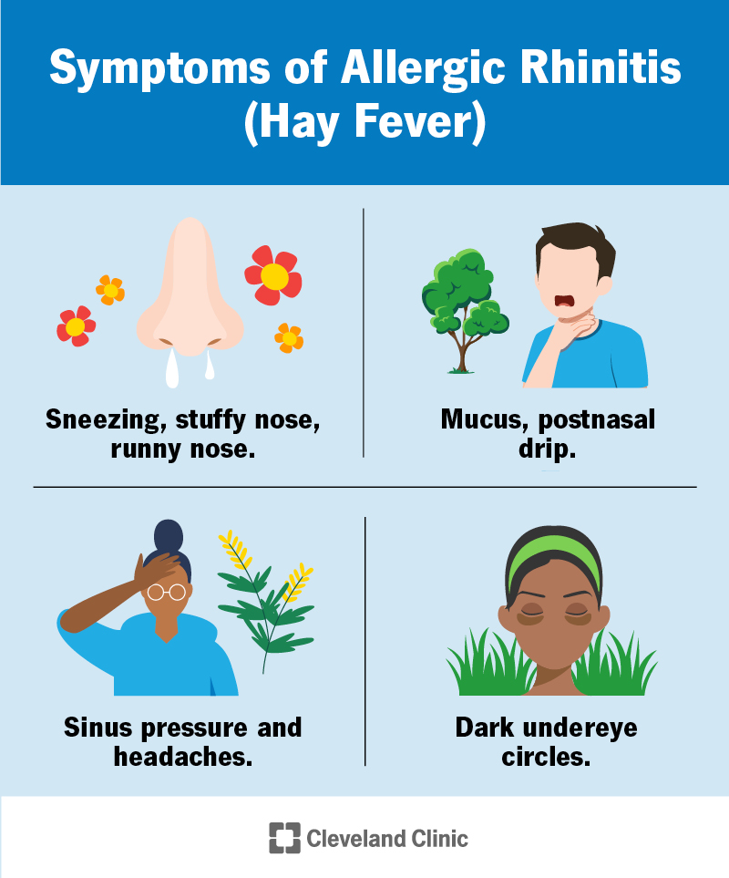 Four symptoms of hay fever are runny nose, postnasal drip, sinus pressure and dark undereye circles.