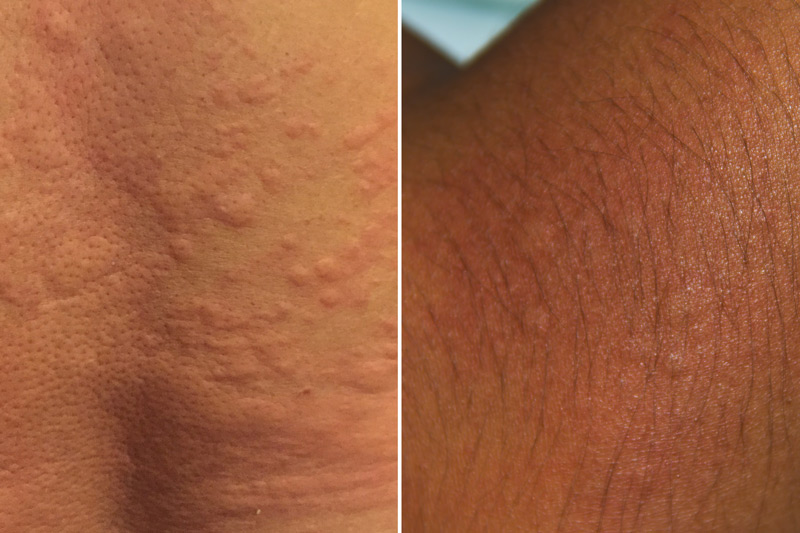 Hives, an itchy and bumpy skin reaction, on lighter skin and on darker skin with dark hair.