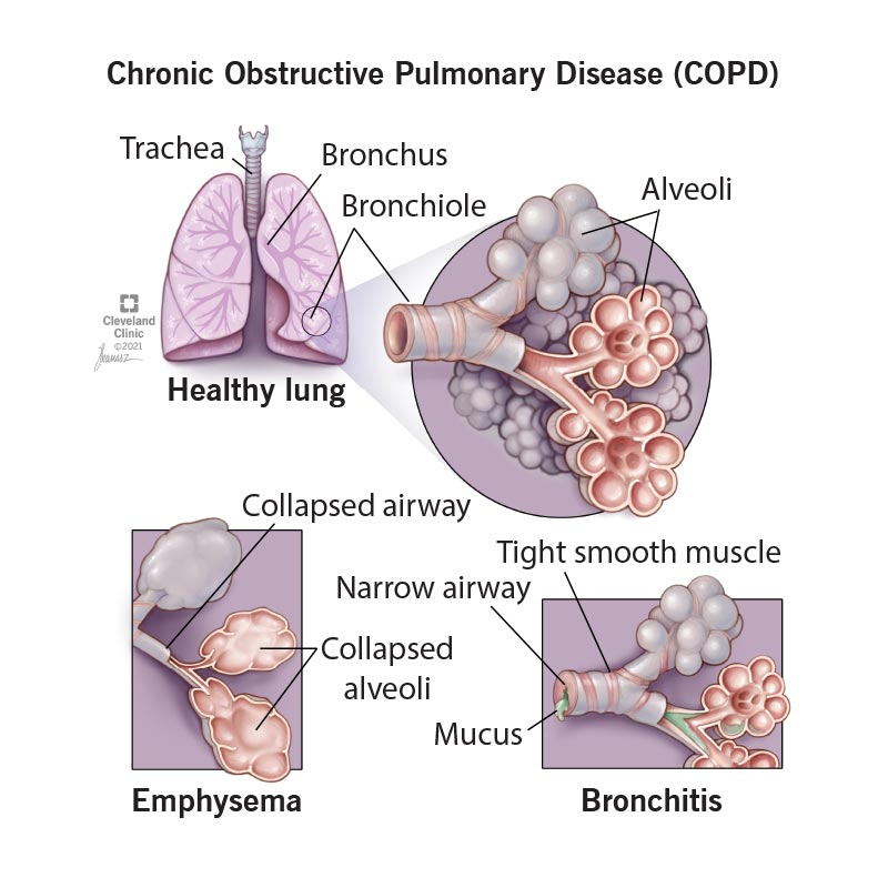 Healthy lung compared to damage to airways and alveoli from COPD, including collapsed airways, mucus and damaged alveoli