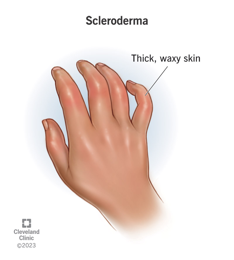Scleroderma symptoms include thickened skin.