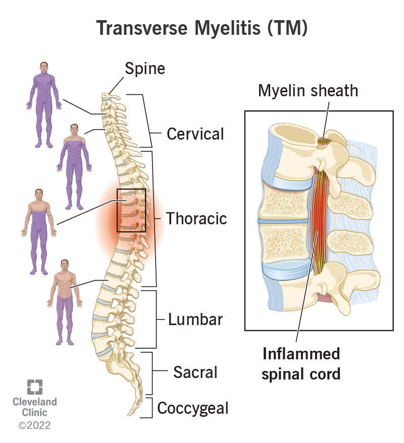 Cervical Spine Infection Care