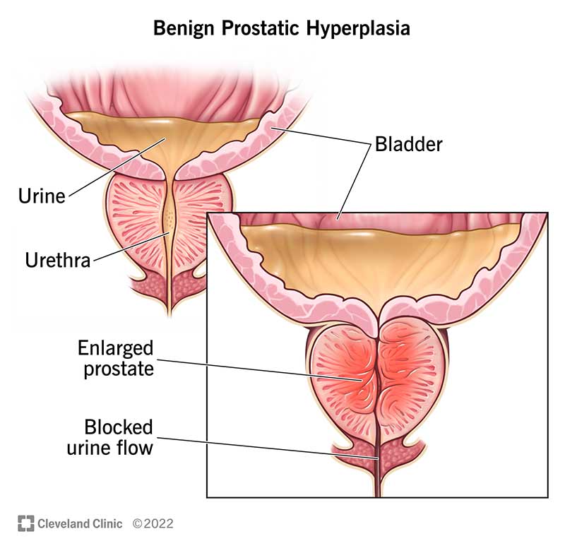 Your prostate surrounds your urethra. Benign prostatic hyperplasia causes your prostate to increase in size. As it gets larger, it can squeeze your urethra and block your urine flow.
