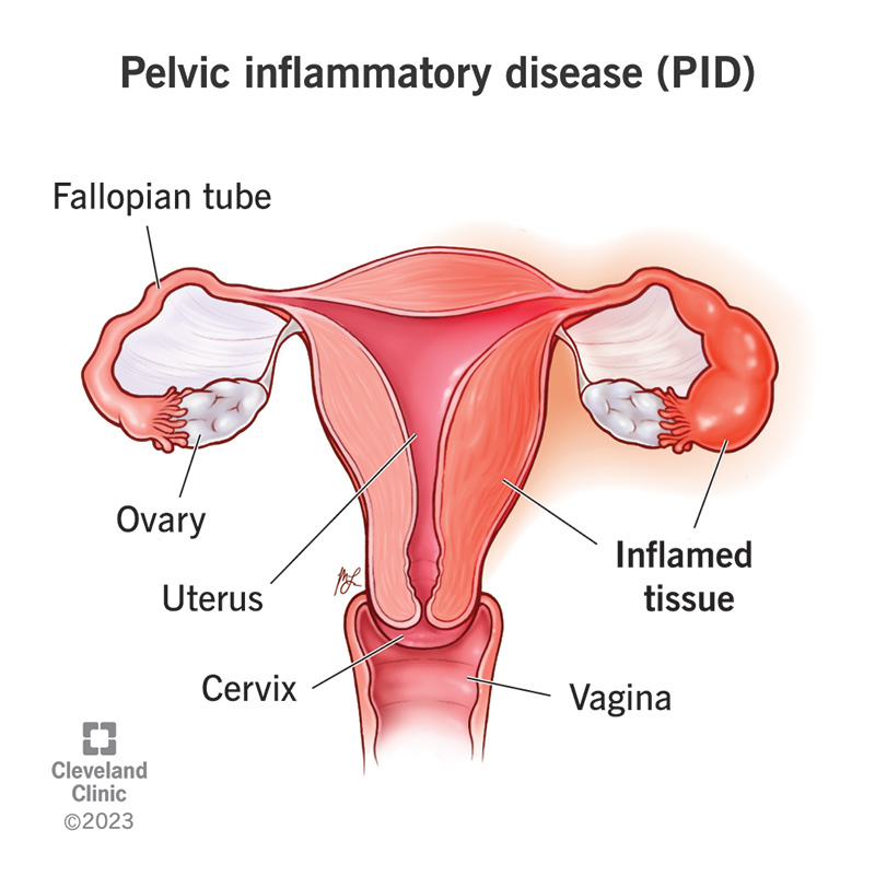 Female reproductive system showing inflamed tissue in the fallopian tubes, uterus and ovaries indicating infection.