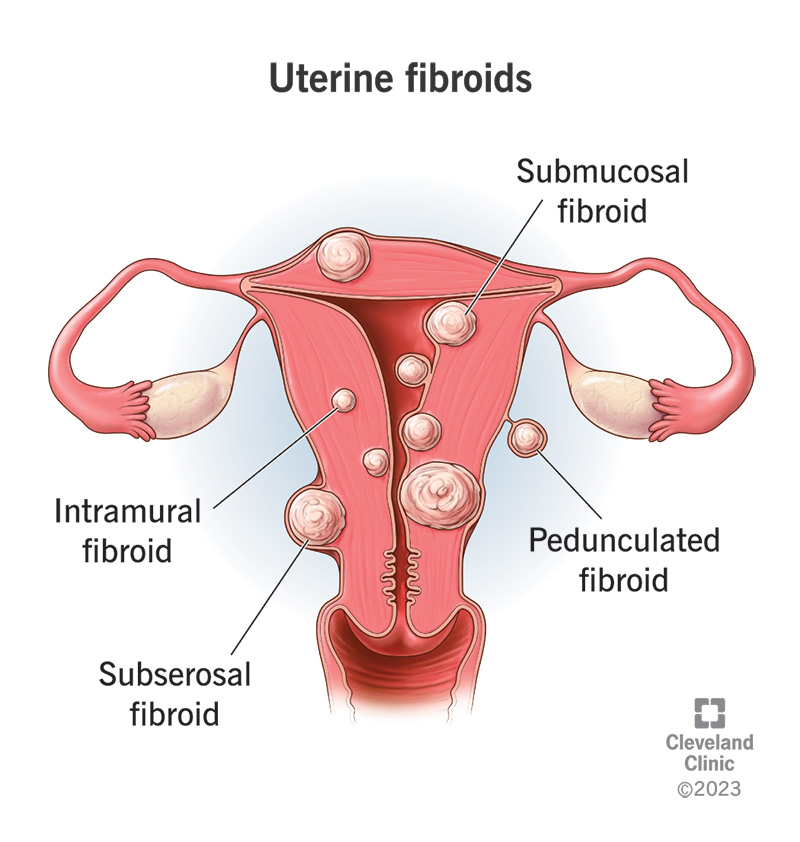 Uterus showing the four types of fibroids and where they can develop.