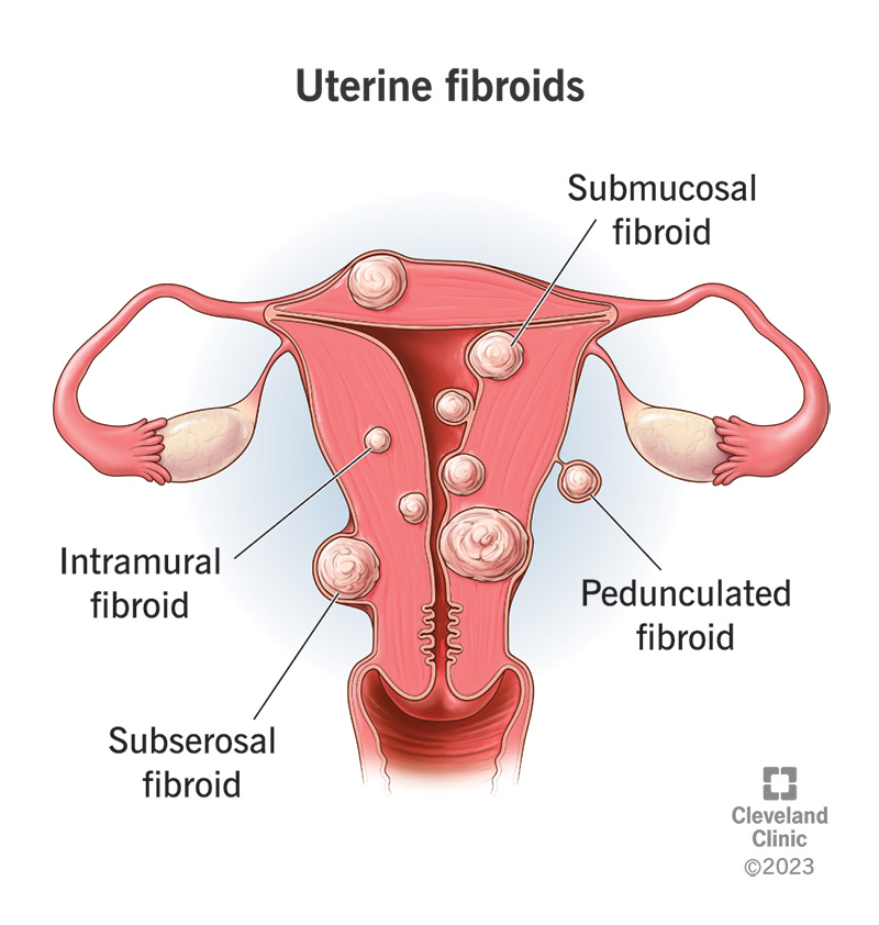 Bulky Uterus: Symptoms, Causes and Treatment