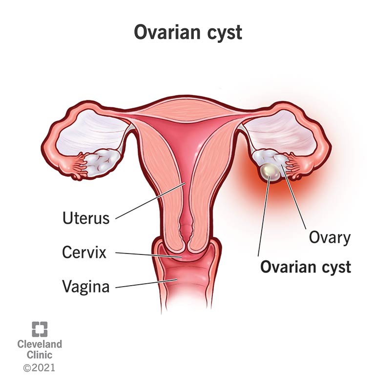 An ovarian cyst forming on an ovary.