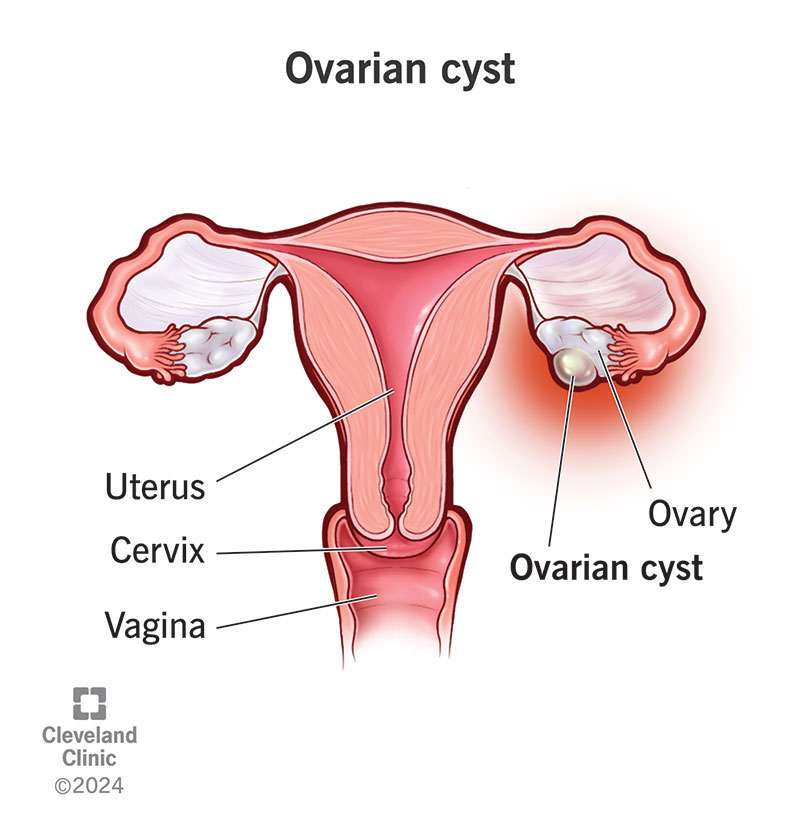 Post Menopausal Simple Ovarian Cysts