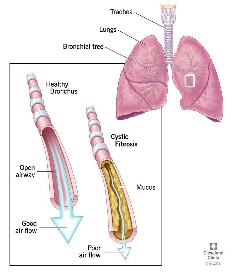 Medical illustration of mucus restricting airflow in cystic fibrosis.