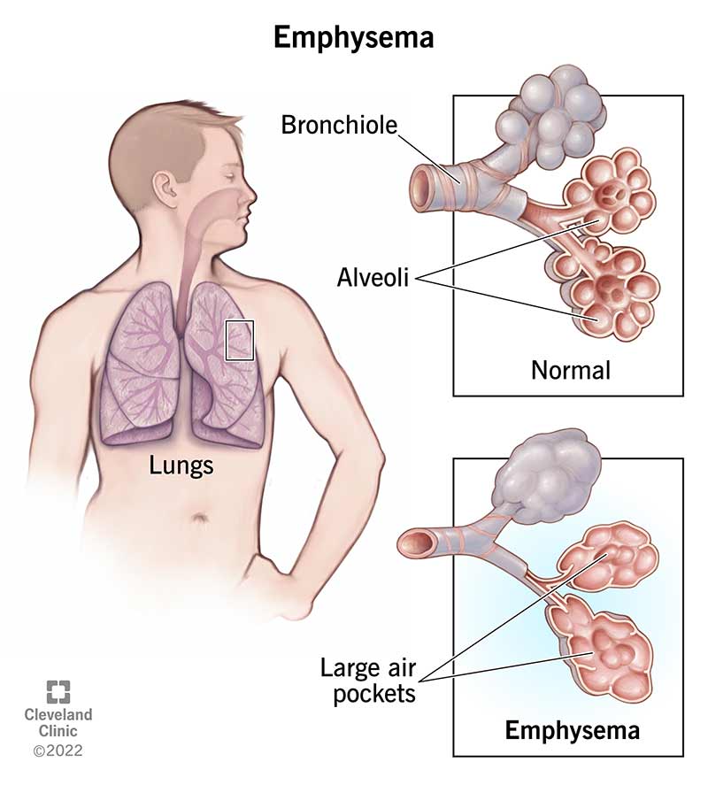 Emphysema damages the alveoli in your lungs, which makes breathing difficult.
