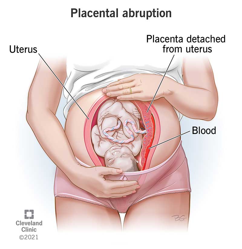 A placenta detached from the uterus with blood pooling underneath during a placental abruption