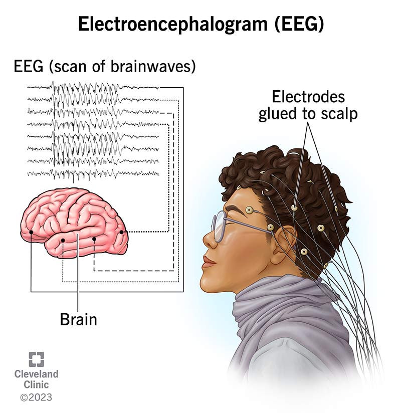 EEGs measure your brainwaves (left). To take the test, providers place electrodes on your head to transmit brain activity.