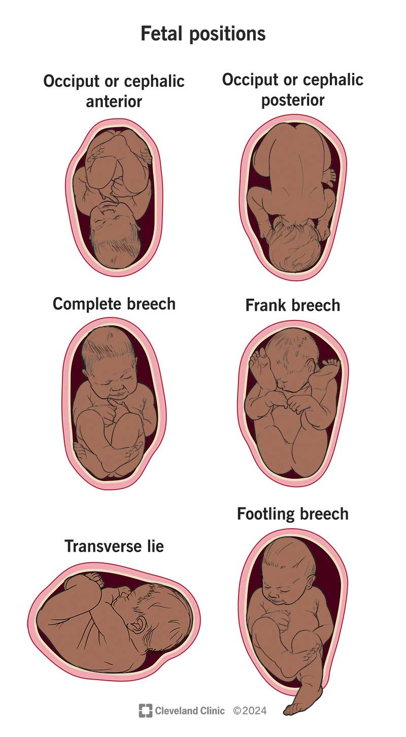 Various fetal positions and what a fetus looks like in the uterus in each one.