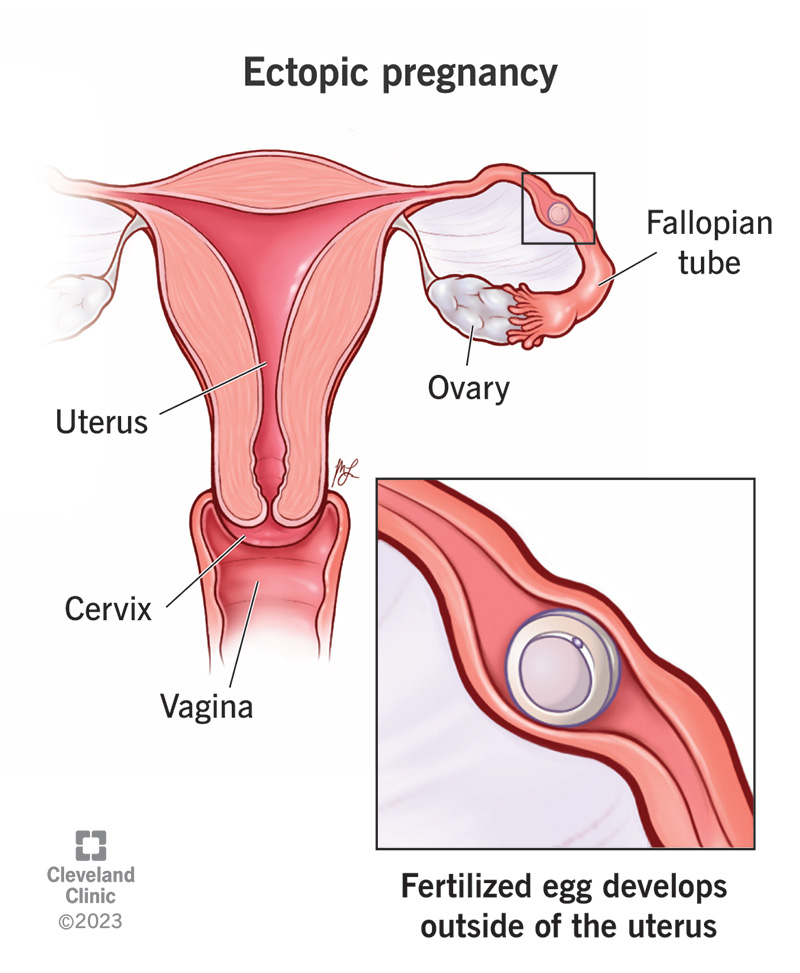 A fertilized egg implanting inside the fallopian tube.