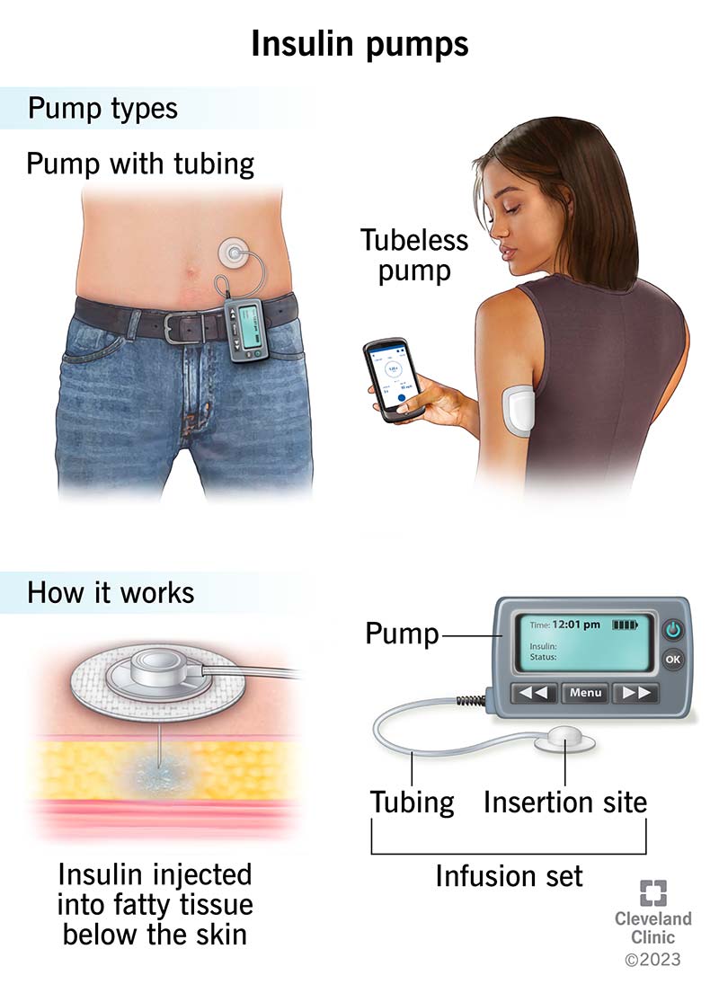 Insulin pumps with tubing and tubeless insulin pumps.