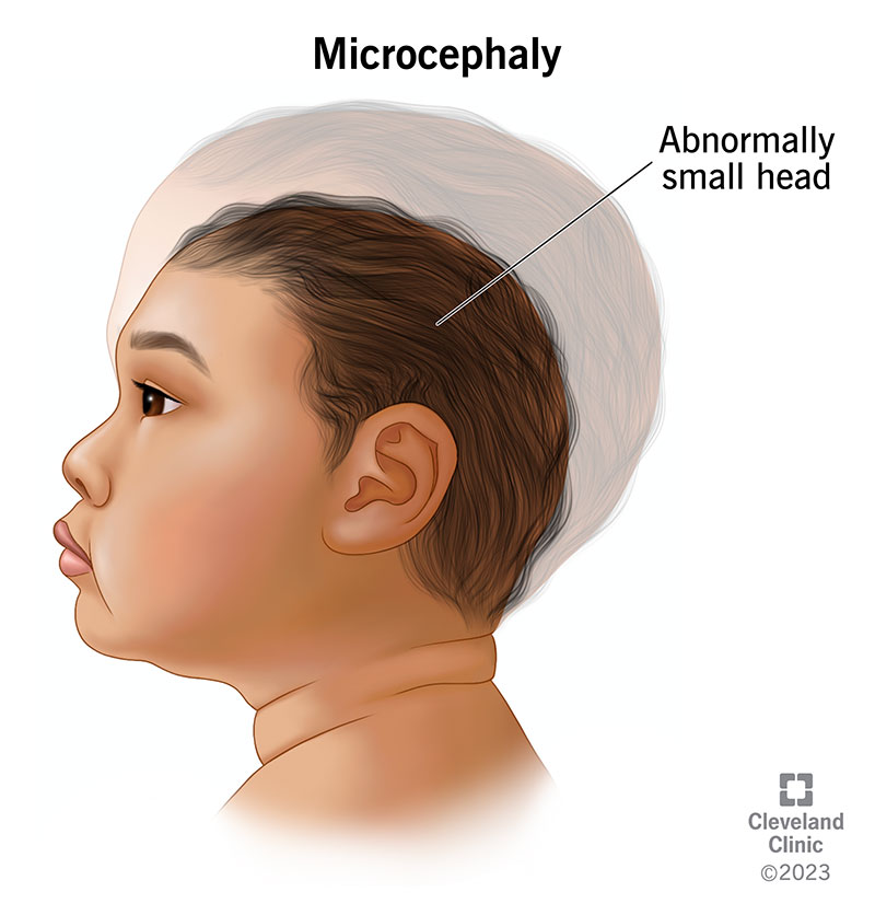 A baby with microcephaly, or a head that’s smaller than expected for their age.